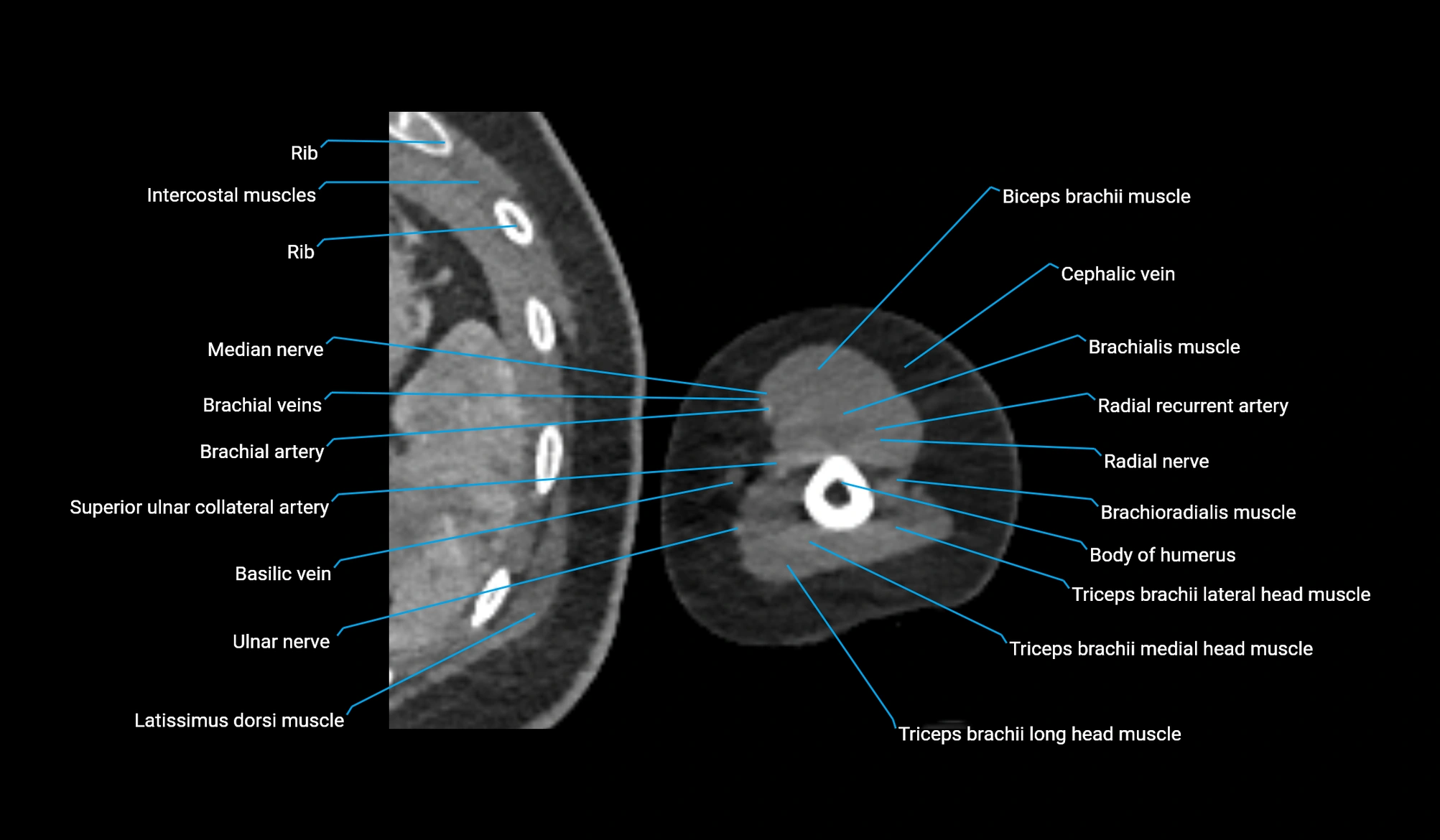 CT upper arm axial  cross sectional anatomy labelled radiology image -00308.webp